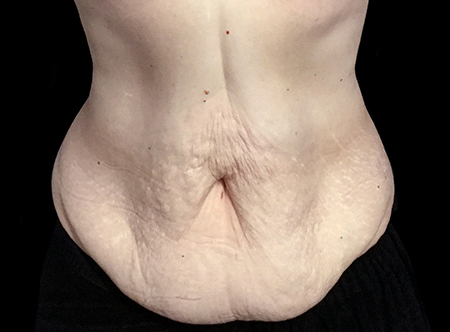 Postpartum abdominoplasty with abdominal wall reconstruction - 124