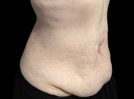 Postpartum abdominoplasty with abdominal wall reconstruction - 125