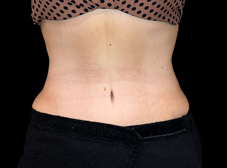 Postpartum abdominoplasty with abdominal wall reconstruction - 127