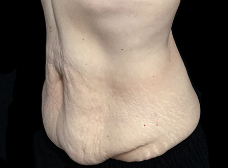 Postpartum abdominoplasty with abdominal wall reconstruction - 126