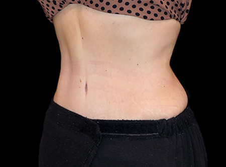 Postpartum abdominoplasty with abdominal wall reconstruction - 129