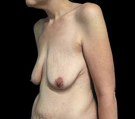 Postpartum abdominoplasty with abdominal wall reconstruction - 9