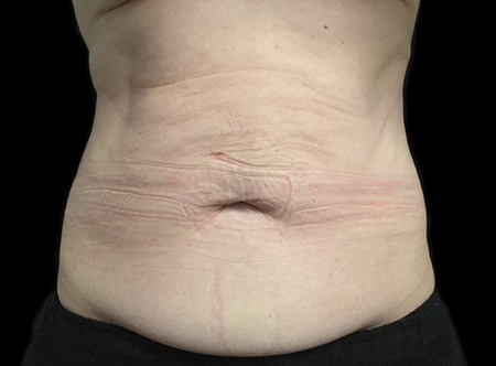 Postpartum abdominoplasty with abdominal wall reconstruction - 148