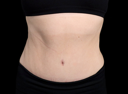 Postpartum abdominoplasty with abdominal wall reconstruction - 151
