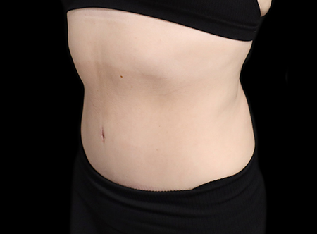 Postpartum abdominoplasty with abdominal wall reconstruction - 153