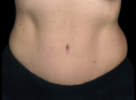 Postpartum abdominoplasty with abdominal wall reconstruction - 115