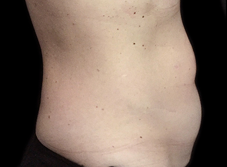 Postpartum abdominoplasty with abdominal wall reconstruction - 114