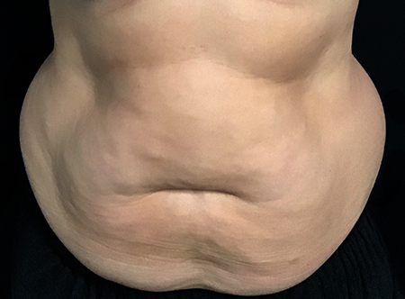Postpartum abdominoplasty with abdominal wall reconstruction - 106