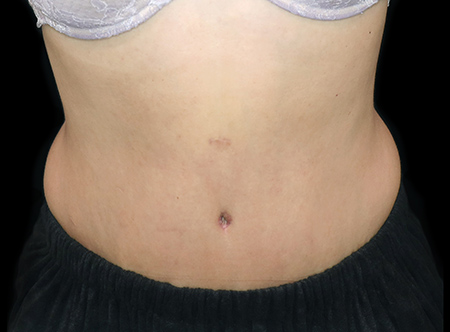 Postpartum abdominoplasty with abdominal wall reconstruction - 109