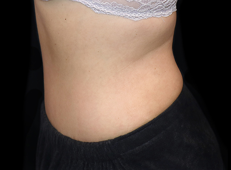 Postpartum abdominoplasty with abdominal wall reconstruction - 110