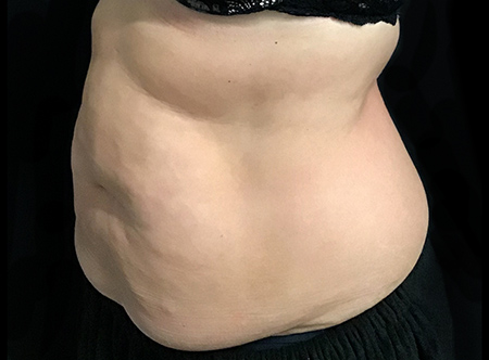 Postpartum abdominoplasty with abdominal wall reconstruction - 108