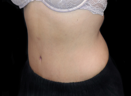 Postpartum abdominoplasty with abdominal wall reconstruction - 111