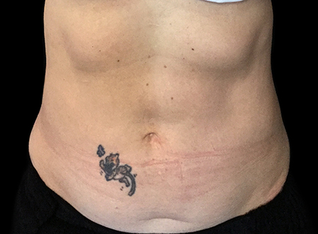 Postpartum abdominoplasty with abdominal wall reconstruction - 100