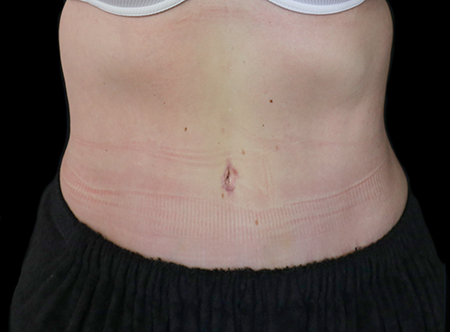 Postpartum abdominoplasty with abdominal wall reconstruction - 103