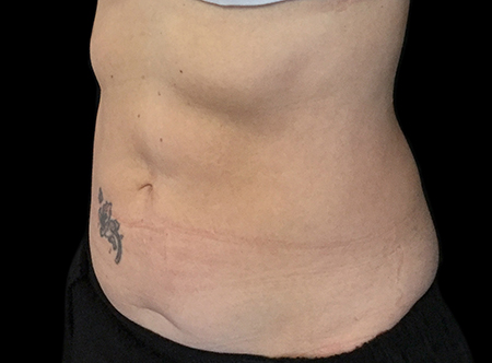 Postpartum abdominoplasty with abdominal wall reconstruction - 101