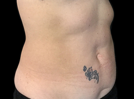 Postpartum abdominoplasty with abdominal wall reconstruction - 102