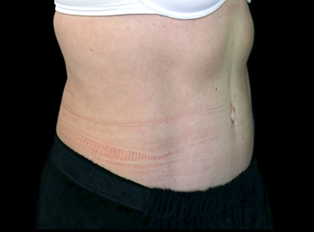 Postpartum abdominoplasty with abdominal wall reconstruction - 105
