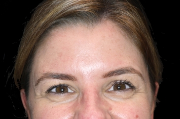 Cosmetic wrinkle injections - 46