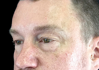 Blepharoplasty – Eyelid lift - 37