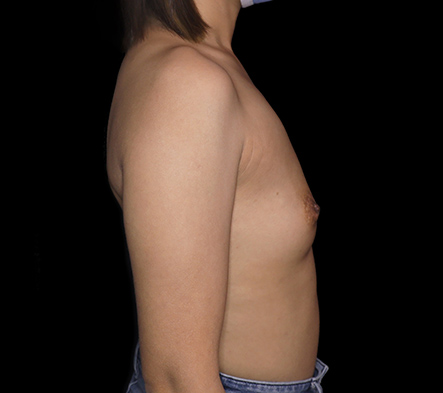 Breast augmentation - 208