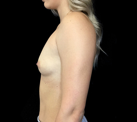 Breast augmentation - 50