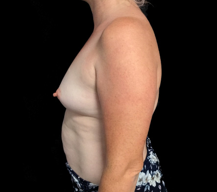 Breast augmentation - 278