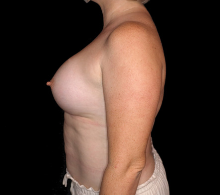 Breast augmentation - 281