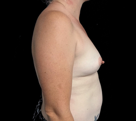 Breast augmentation - 280