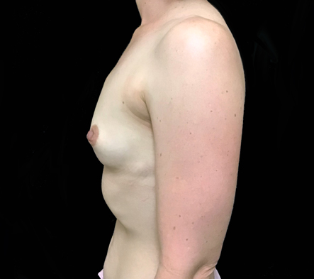 Breast augmentation - 266