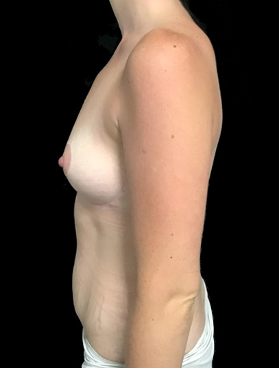 Postpartum abdominoplasty with abdominal wall reconstruction - 50