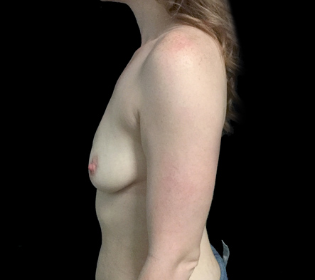 Mastopexy - breast lift - 43