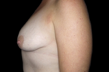 Mastopexy - breast lift - 23