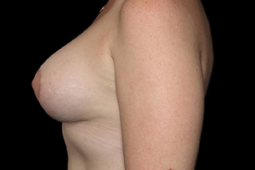 Breast Augmentation and Lift - 6