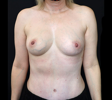Breast fat grafting surgery - 26