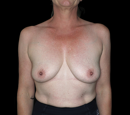 Breast Augmentation and Lift - 13