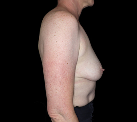 Mastopexy - breast lift - 33