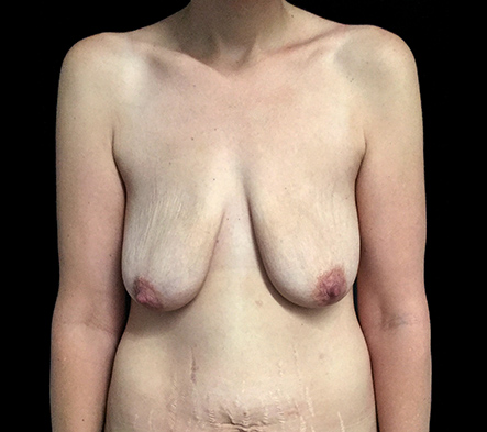 Combined Breast Augmentation, Mastopexy + Abdominoplasty - 7