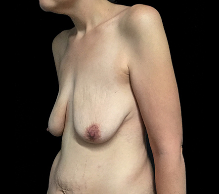 Combined Breast Augmentation, Mastopexy + Abdominoplasty - 8