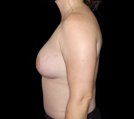 Combined Breast Augmentation, Mastopexy + Abdominoplasty - 6