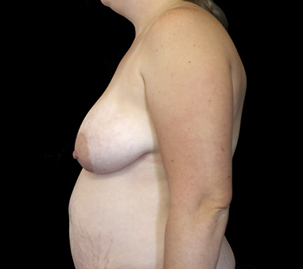 Mastopexy - breast lift - 25