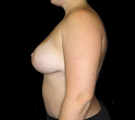 Breast Augmentation and Lift - 10