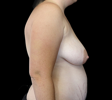 Breast Augmentation and Lift - 8