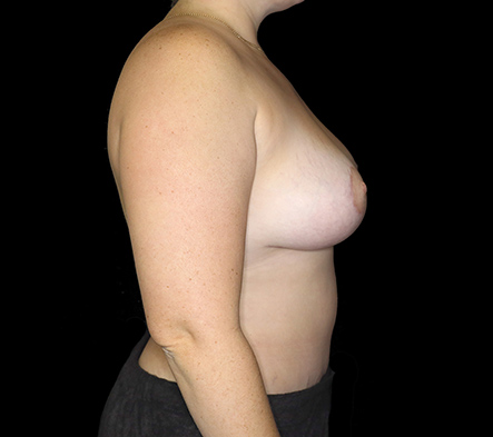 Breast Augmentation and Lift - 11