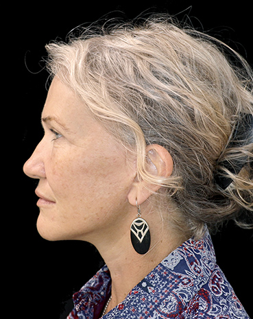 Right side view, facelift patient after procedure 1b