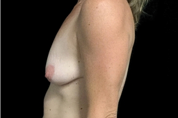 Breast Augmentation and Lift - 1