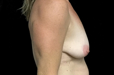 Mastopexy - breast lift - 20