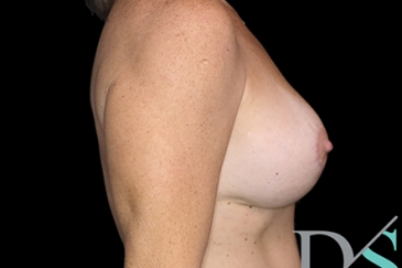 Mastopexy - breast lift - 22