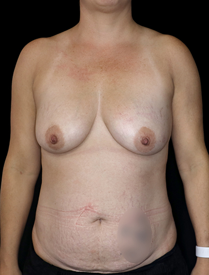 Postpartum abdominoplasty with abdominal wall reconstruction - 32