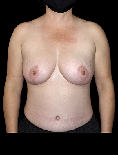 Breast fat grafting surgery - 14
