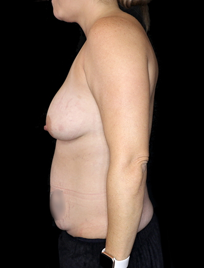 Postpartum abdominoplasty with abdominal wall reconstruction - 34